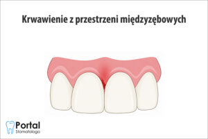 Krwawienie z przestrzeni międzyzębowych