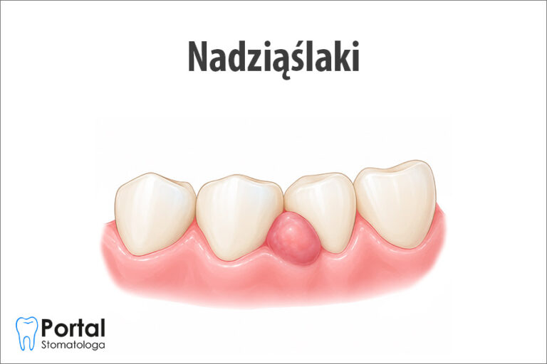 Nadziąślaki