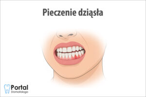 Pieczenie dziąsła
