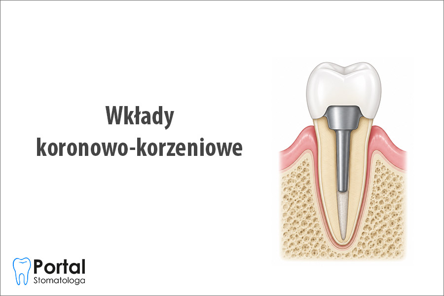 Wkłady koronowo-korzeniowe