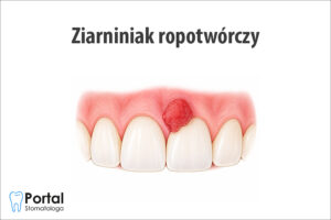 Ziarniniak ropotwórczy