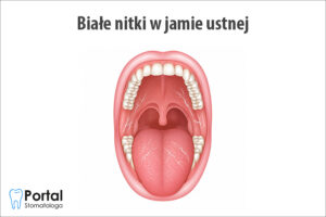 Białe nitki w jamie ustnej