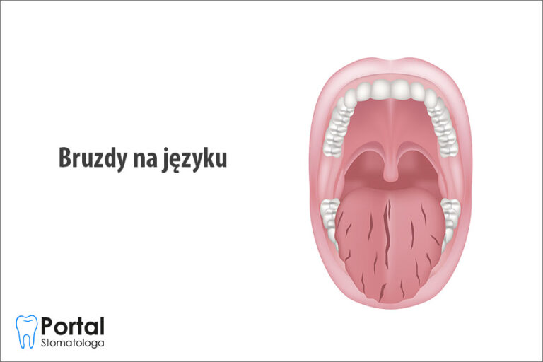 Bruzdy na języku