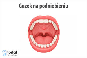 Guzek na podniebieniu