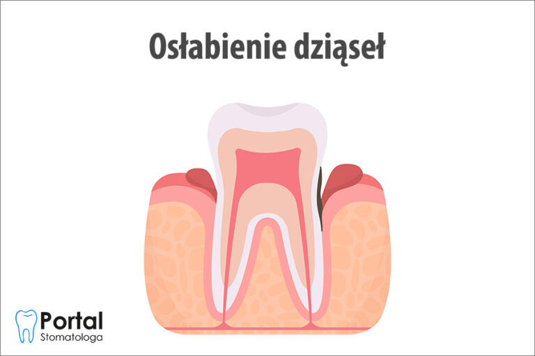Osłabienie dziąseł
