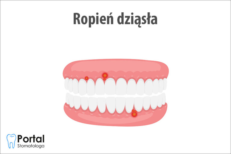 Ropień dziąsła