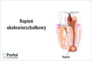 Ropień okołowierzchołkowy