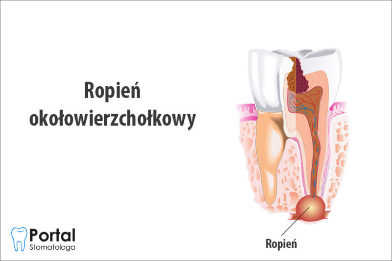 Ropień okołowierzchołkowy