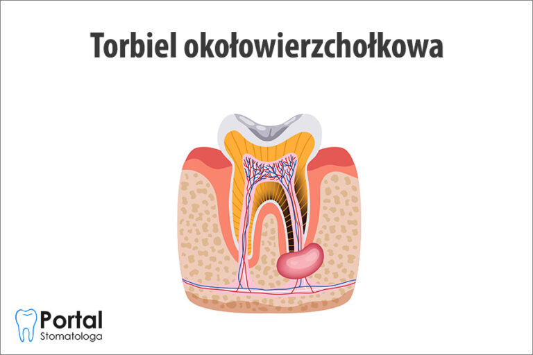 Torbiel okołowierzchołkowa