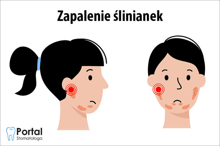 Zapalenie ślinianek