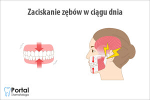 Zaciskanie zębów w ciągu dnia