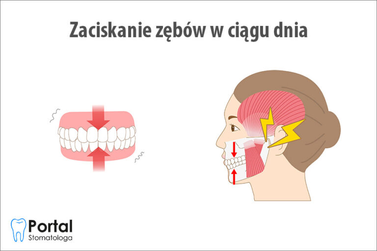 Zaciskanie zębów w ciągu dnia